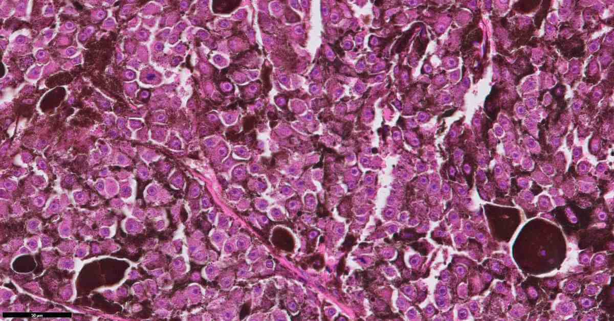 Cellule di melanoma maligno in un gatto al microscopio